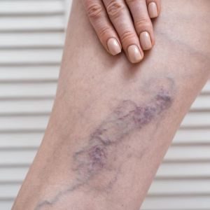 Spider Vein Treatment