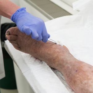 Venous Ulcer Treatment