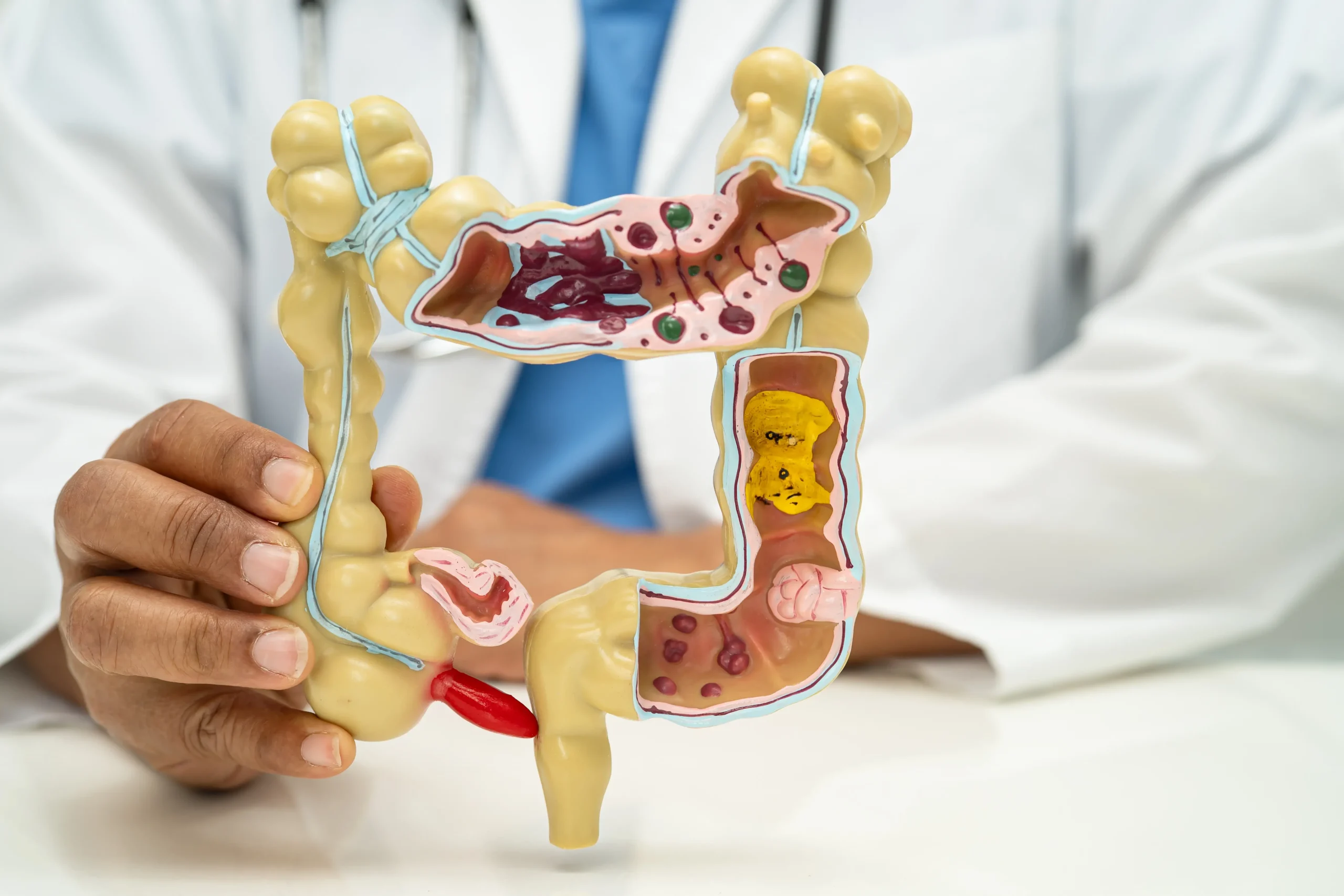 Colectomy in Thane Colectomy in Thane