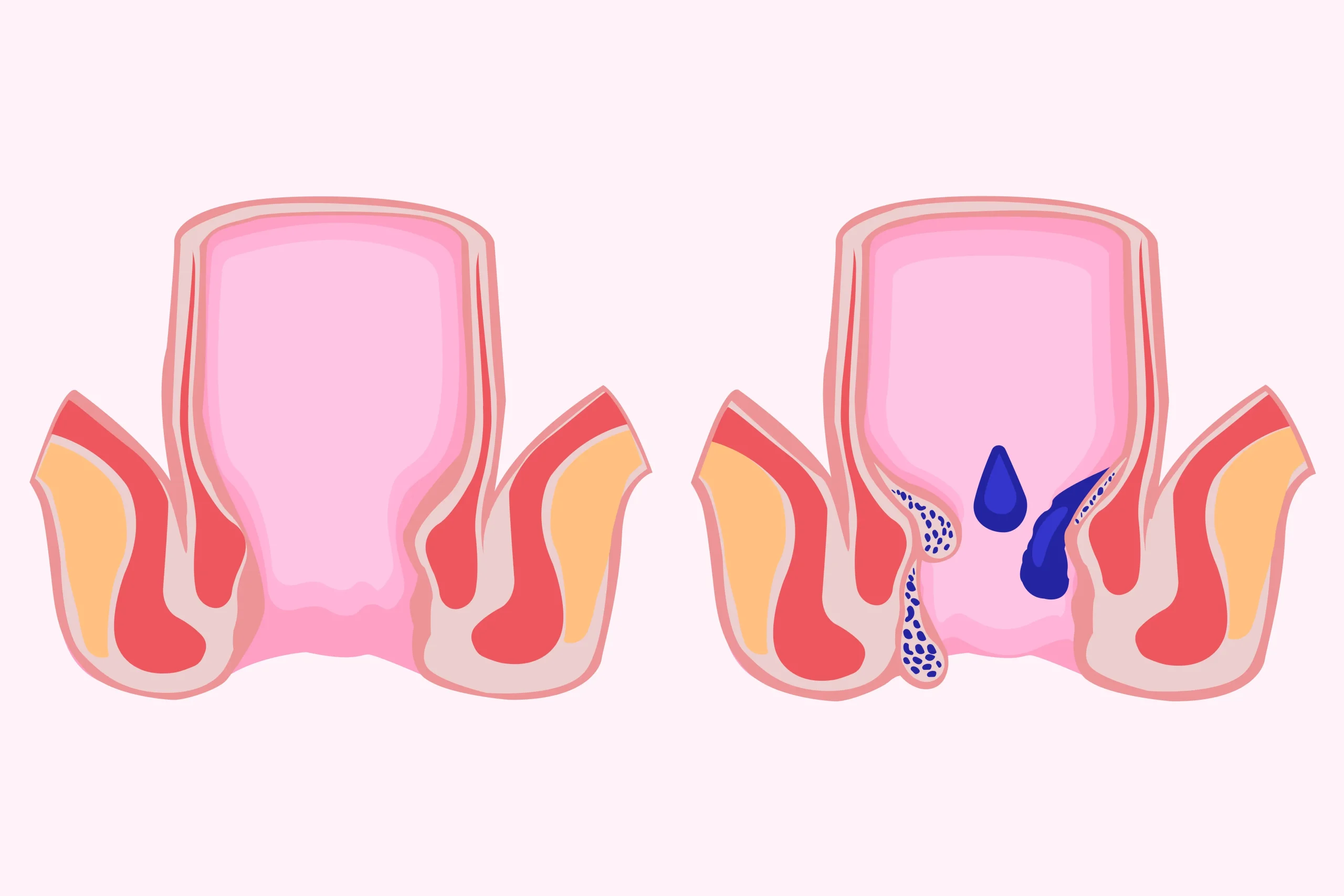 Fissure Surgery in Thane Fissure Surgery in Thane