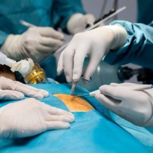 Fissure Surgery