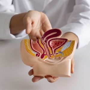 Fistula Treatment1