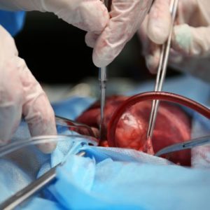 Hydrocele Surgery