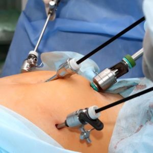 Laparoscopic Appendectomy