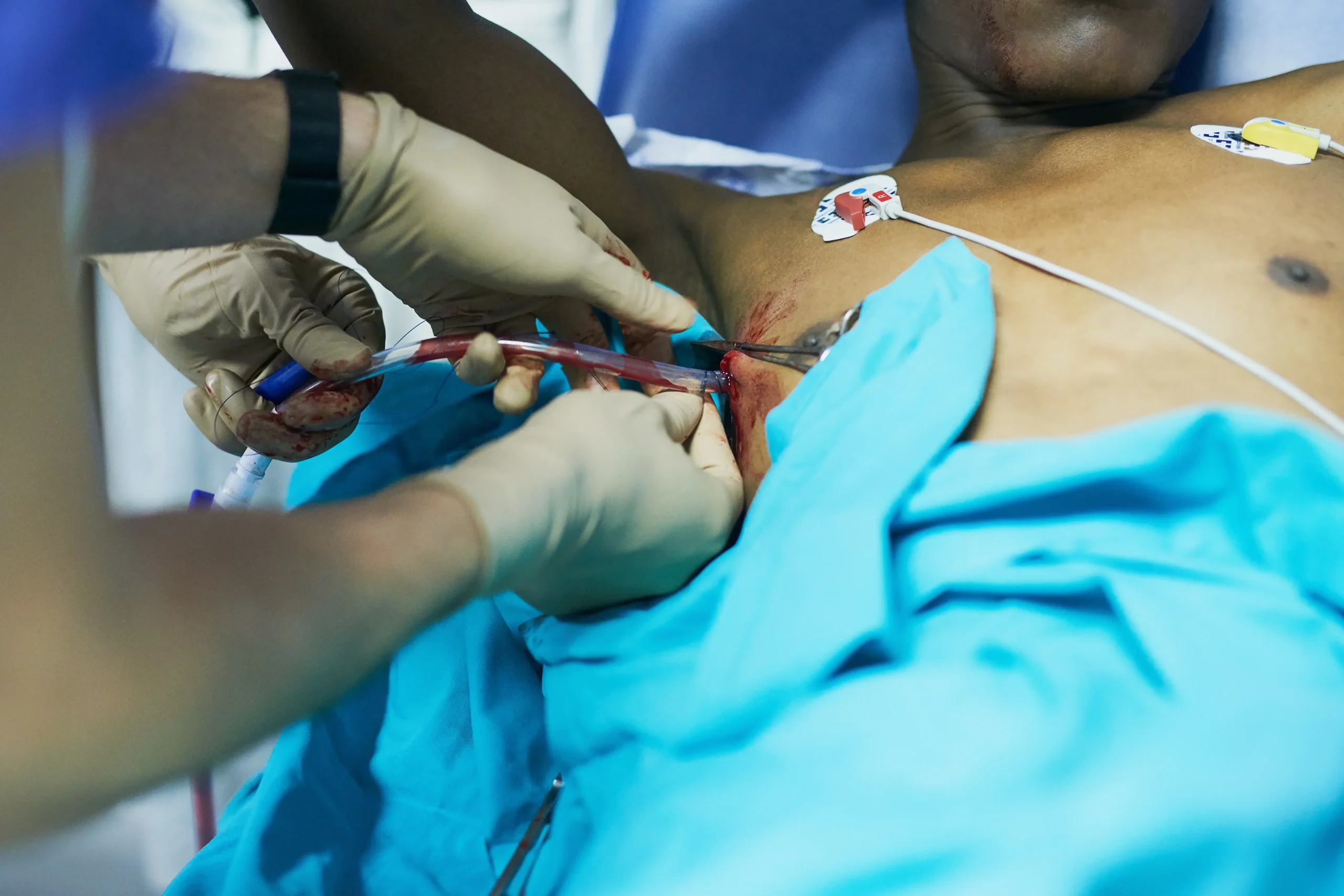 Tunnel Catheter Insertion Tunnel Catheter Insertion