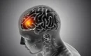 Causes of a Stroke in a Woman