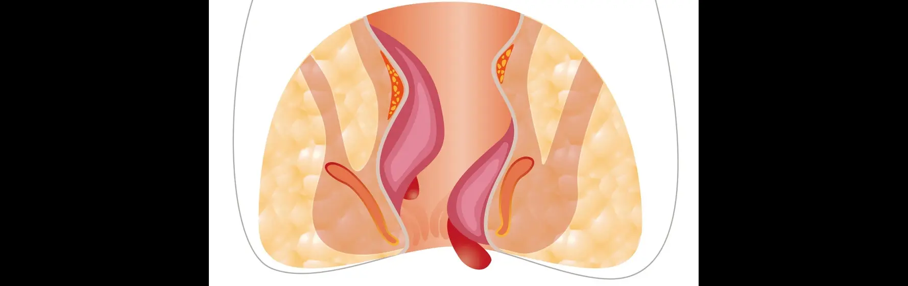 Symptoms of Piles in Female