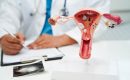 Can Endometriosis Cause Cancer?