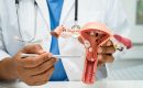 Difference Between Endometriosis and Ovarian Cyst