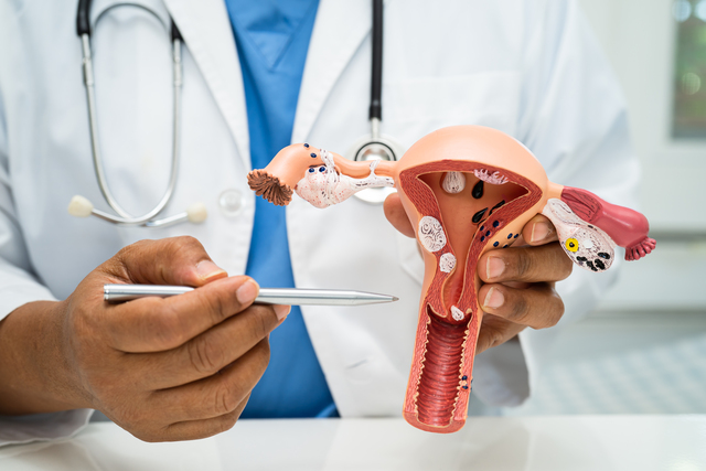 Difference Between Endometriosis and Ovarian Cyst