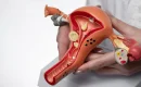Stage 4 Endometriosis