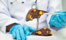 Liver Cirrhosis Stages: When Is Transplant Needed?