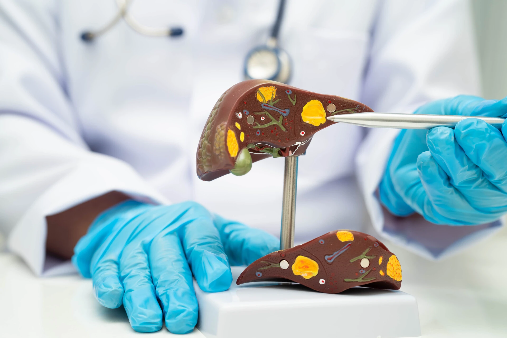 Liver Cirrhosis Stages: When Is Transplant Needed?
