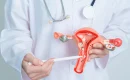 Uterine Fibroids: Is Hysterectomy Always Needed?