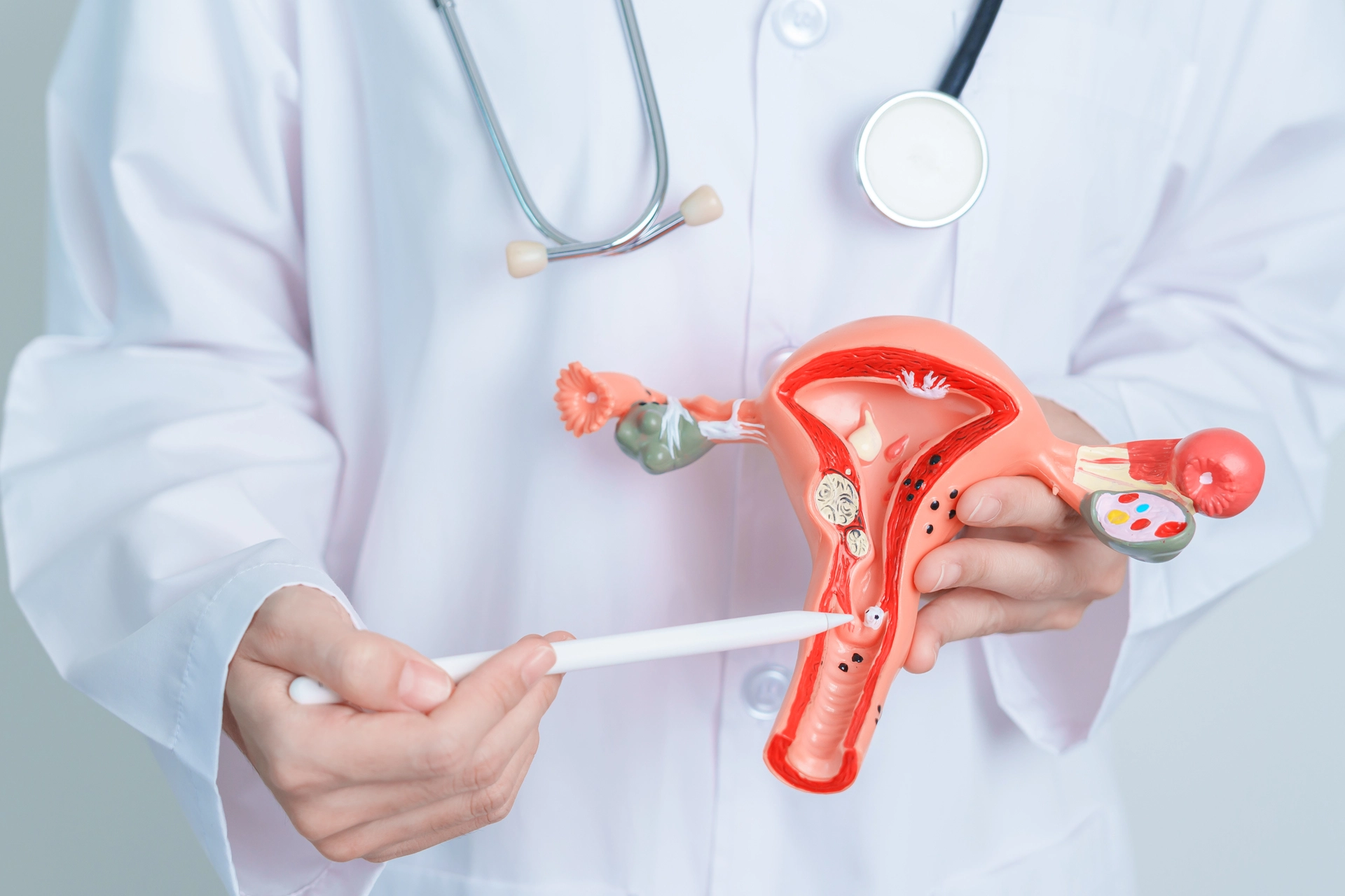 Uterine Fibroids: Is Hysterectomy Always Needed?